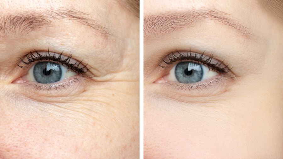 Before and after Botox treatment showing reduced crow's feet wrinkles around the eyes