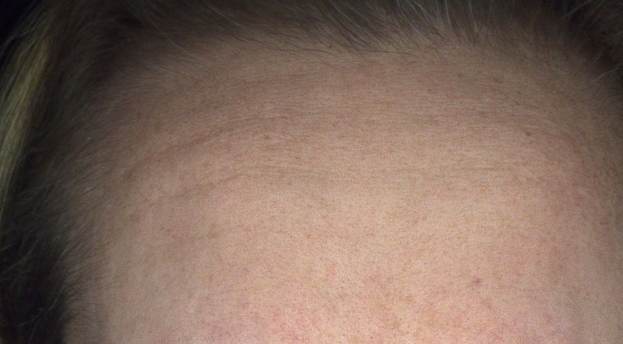 Alma IQ forehead skin scan showing tracked skin condition at a later visit
