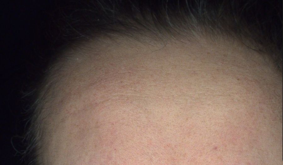 Alma IQ forehead skin scan showing baseline skin condition