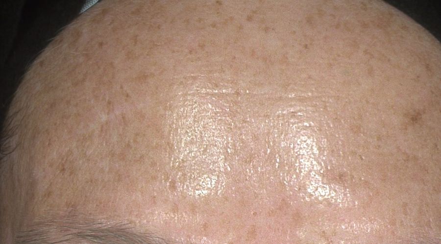Alma IQ forehead skin scan showing reduced pigmentation at a later visit