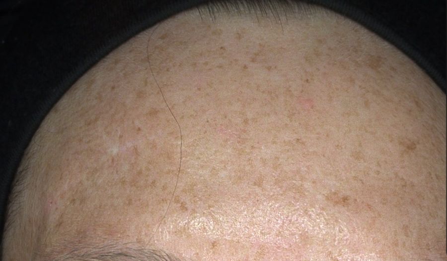 Alma IQ forehead skin scan showing sun damage and pigmentation at baseline