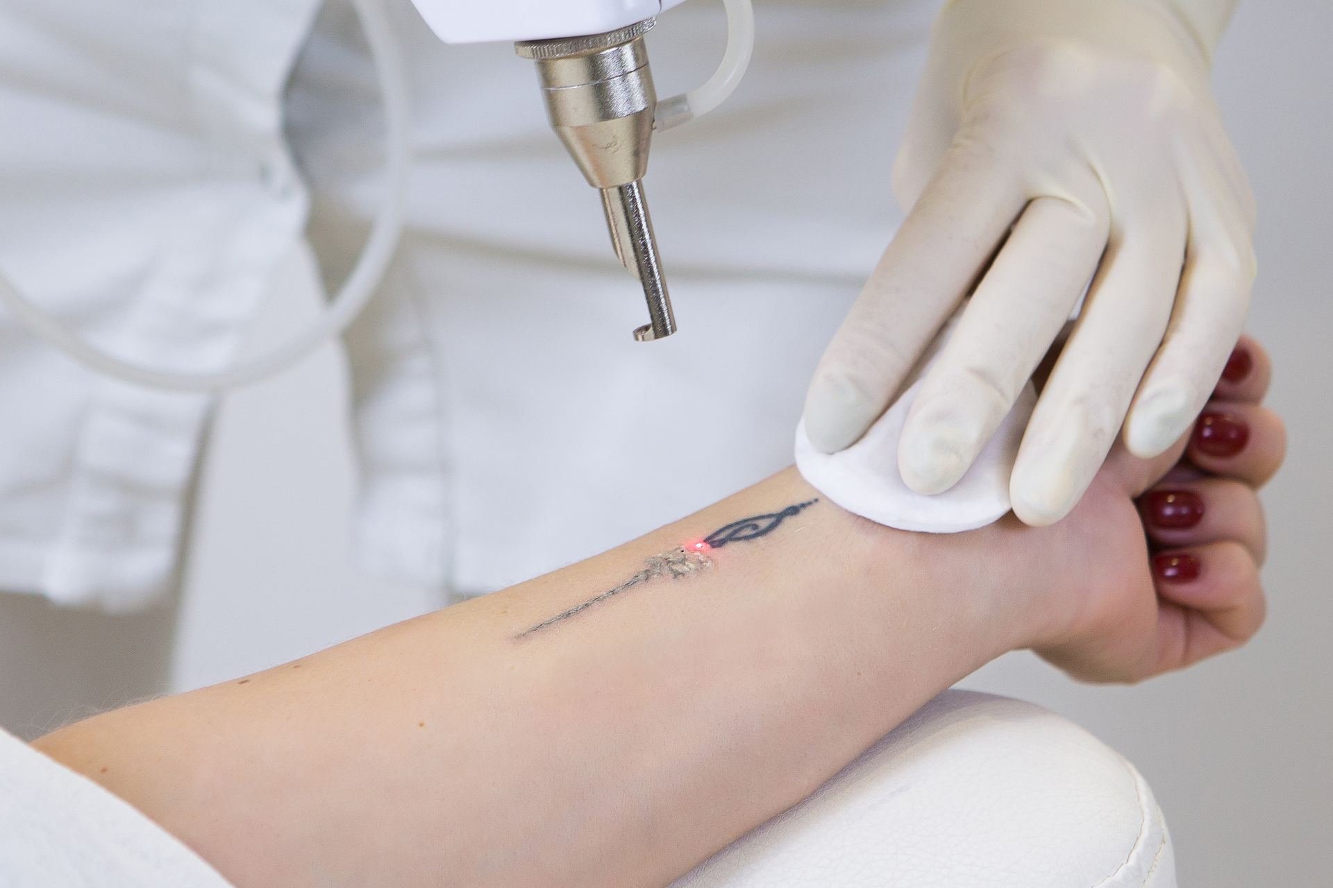 Laser tattoo removal treatment in progress on a forearm tattoo