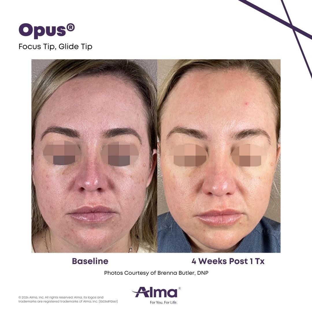 Before and after photo of a woman's face showing improved skin texture and tone 4 weeks after one Opus Plasma treatment