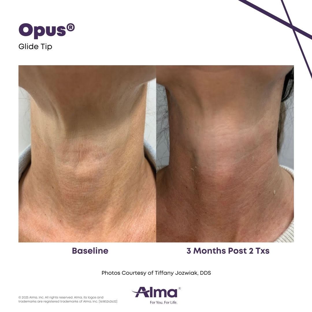 Before and after photo of a neck showing firmer, smoother skin 3 months after two Opus Plasma treatments