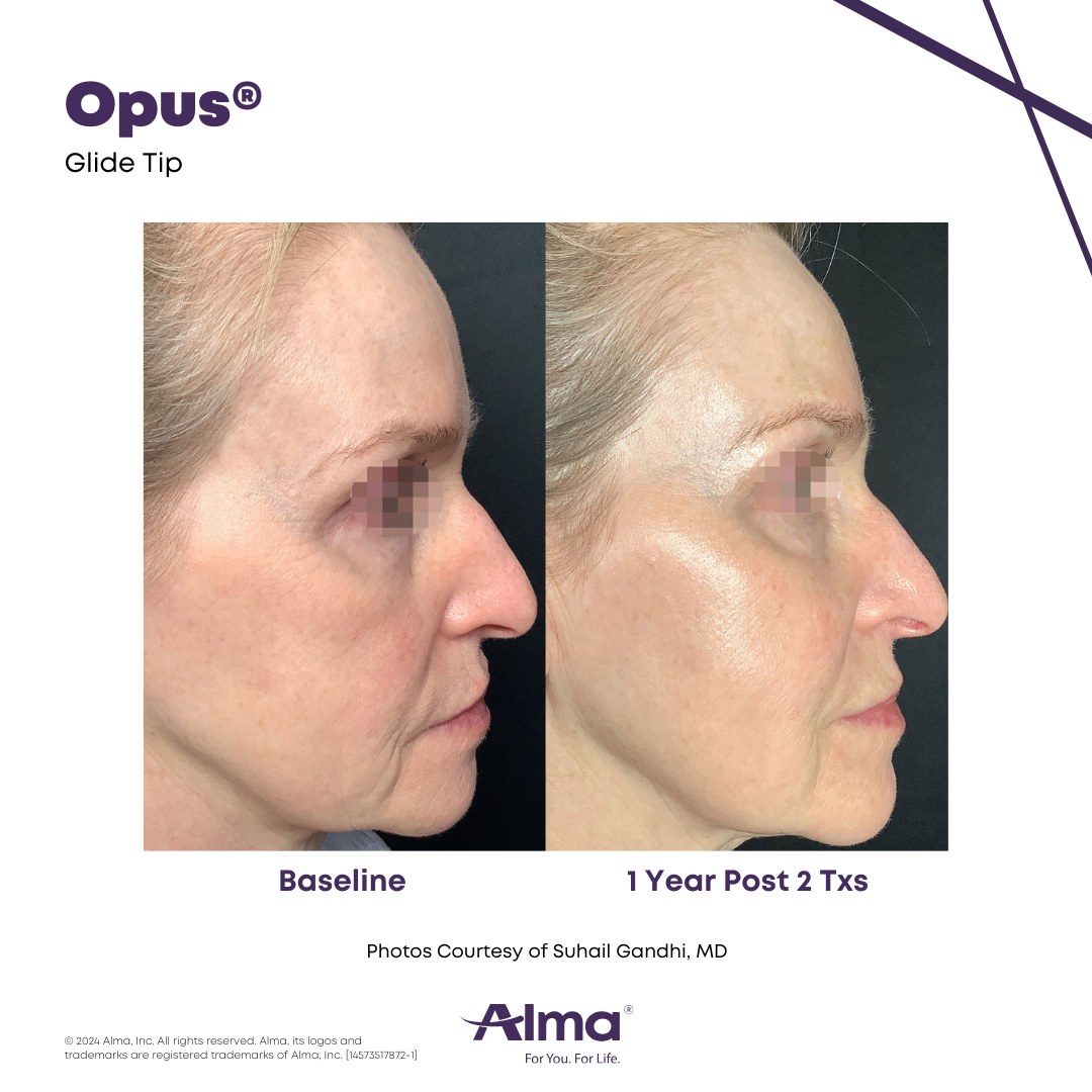 Before and after profile photo showing firmer, smoother facial skin 1 year after two Opus Plasma treatments