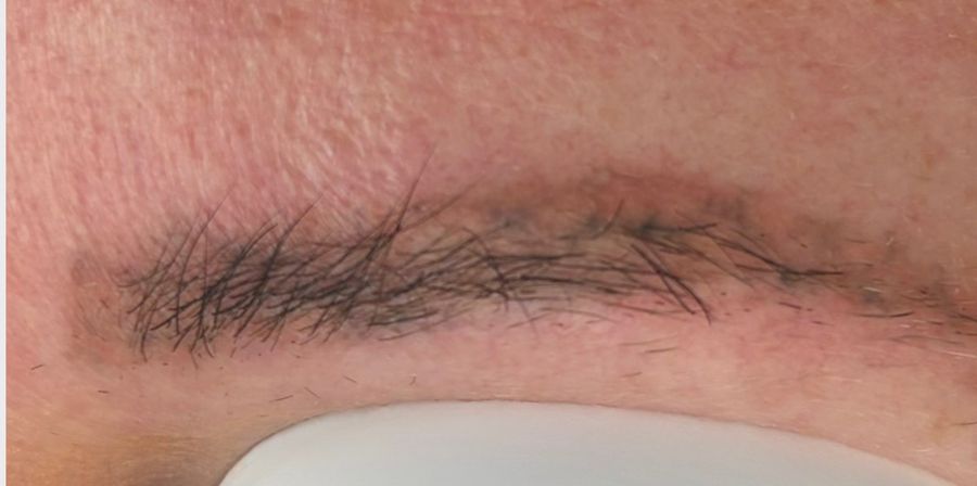 After a course of laser tattoo removal sessions, showing dramatically faded ink