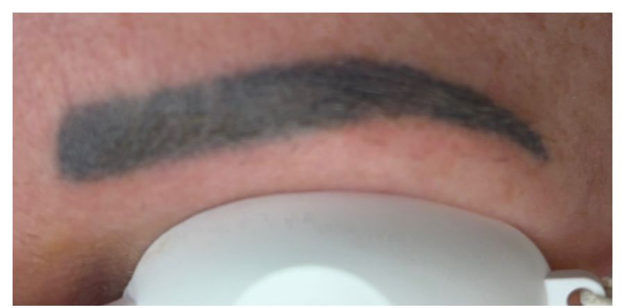 Before laser tattoo removal treatment, showing dense dark ink