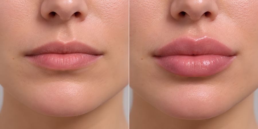 Before and after lip filler treatment showing fuller, more defined lips