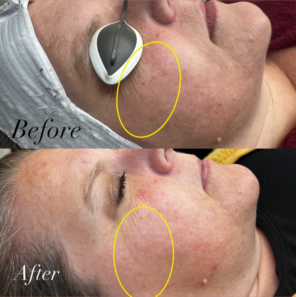 Before and after photofacial: overall skin brightness after one Dye-VL treatment at Abbott Health & Wellness